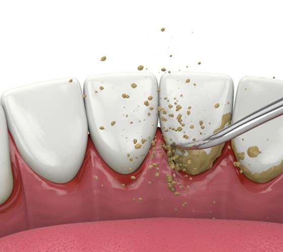 Illustration of tartar being removed from lower teeth