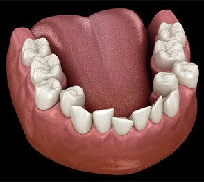 Illustration of crowded teeth