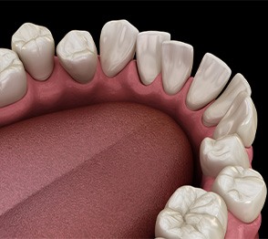 Illustration of gapped teeth