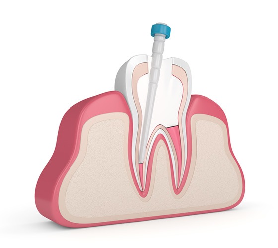3D model of a root canal