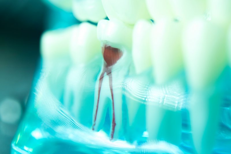 Illustration of infected dental pulp